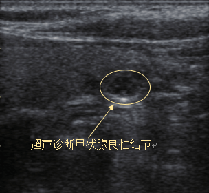 南昌博大甲状腺七个问答全面了解甲状腺结节