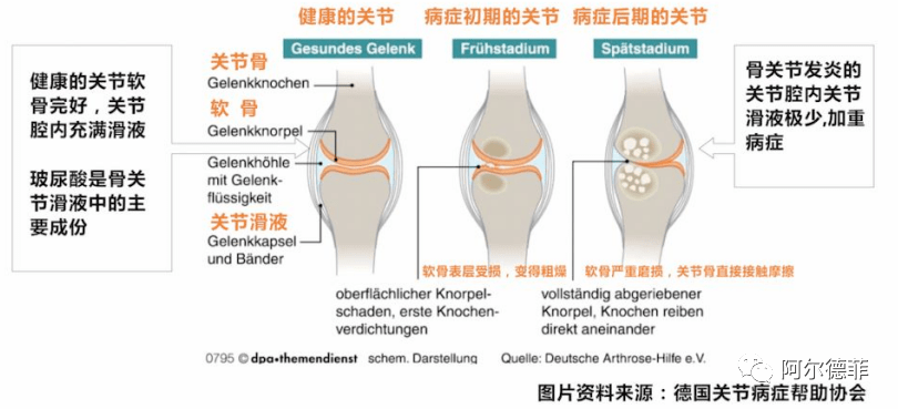 67关节滑液的润滑作用_软骨