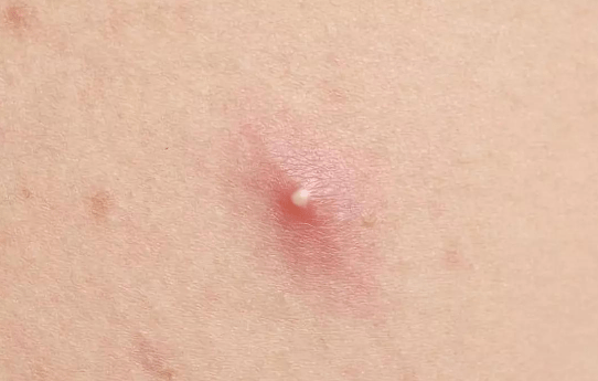 什么是单纯疱疹1型 d25cbe9ab0d742628d7bb2d5839104d4.png