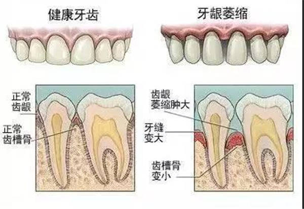 牙缝大怎么办（年龄大了牙齿稀疏牙缝大怎么办）