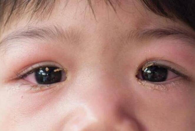若是孩子眼睛出现4种信号,脾胃八成已"烂如渔网",父母
