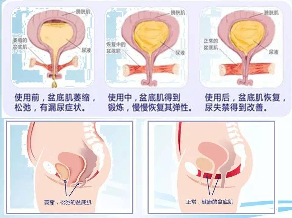 子宫脱垂只能做切除术?想保住子宫,就来了解下子宫腹腔悬吊术!