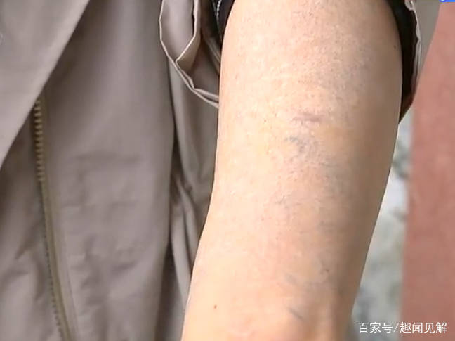 女子花3万洗纹身,洗了10次胳膊都是白色斑点,院方:效果很明显