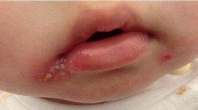 【烂嘴角】烂嘴角是怎么回事_烂嘴角的治疗方法