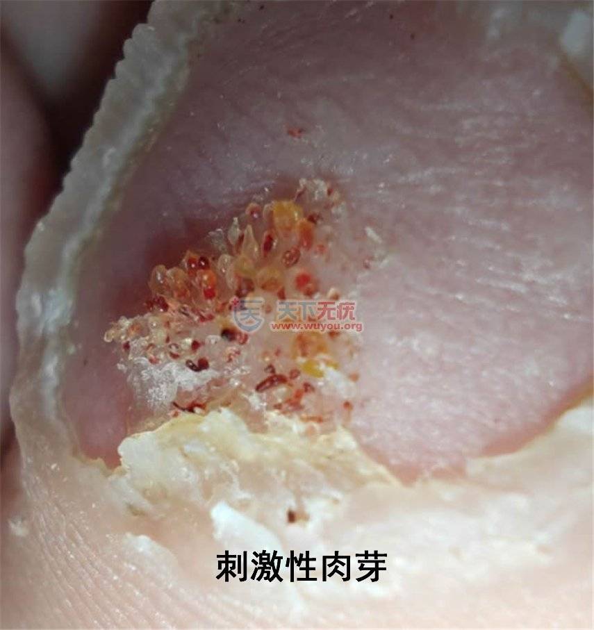 腐蚀性肉芽一般为在疣体上面,为单个出现,相对来说较大. 刺激