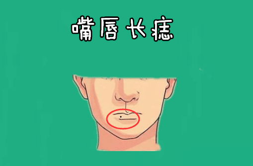 嘴唇长痣