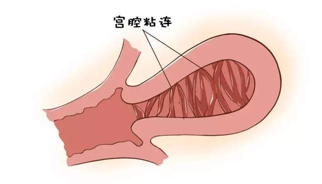 宫腔粘连会影响月经?会影响生育吗?