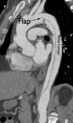 什么是主动脉夹层呢 a616a914d0114a40a9f4d57a2c4ef572.png