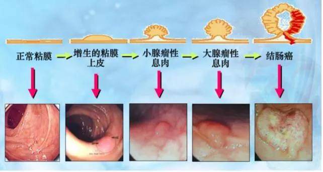 x光,ct,磁共振等最新技术等也往往不易早期发现,以致不少大肠息肉患者