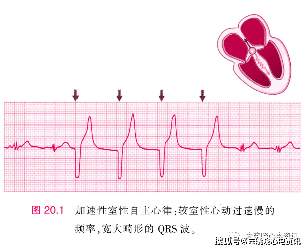 心律规整的宽qrs波心律