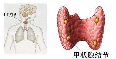 甲状腺结节术后不排除可能会有并发症导致终身服药,出现声音嘶哑等不