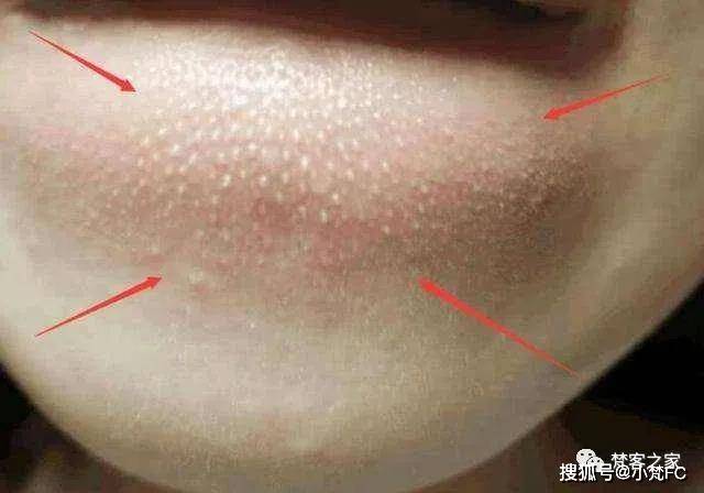 【皮肤管理】下巴凸起小颗粒是闭口痘痘?脂肪粒?