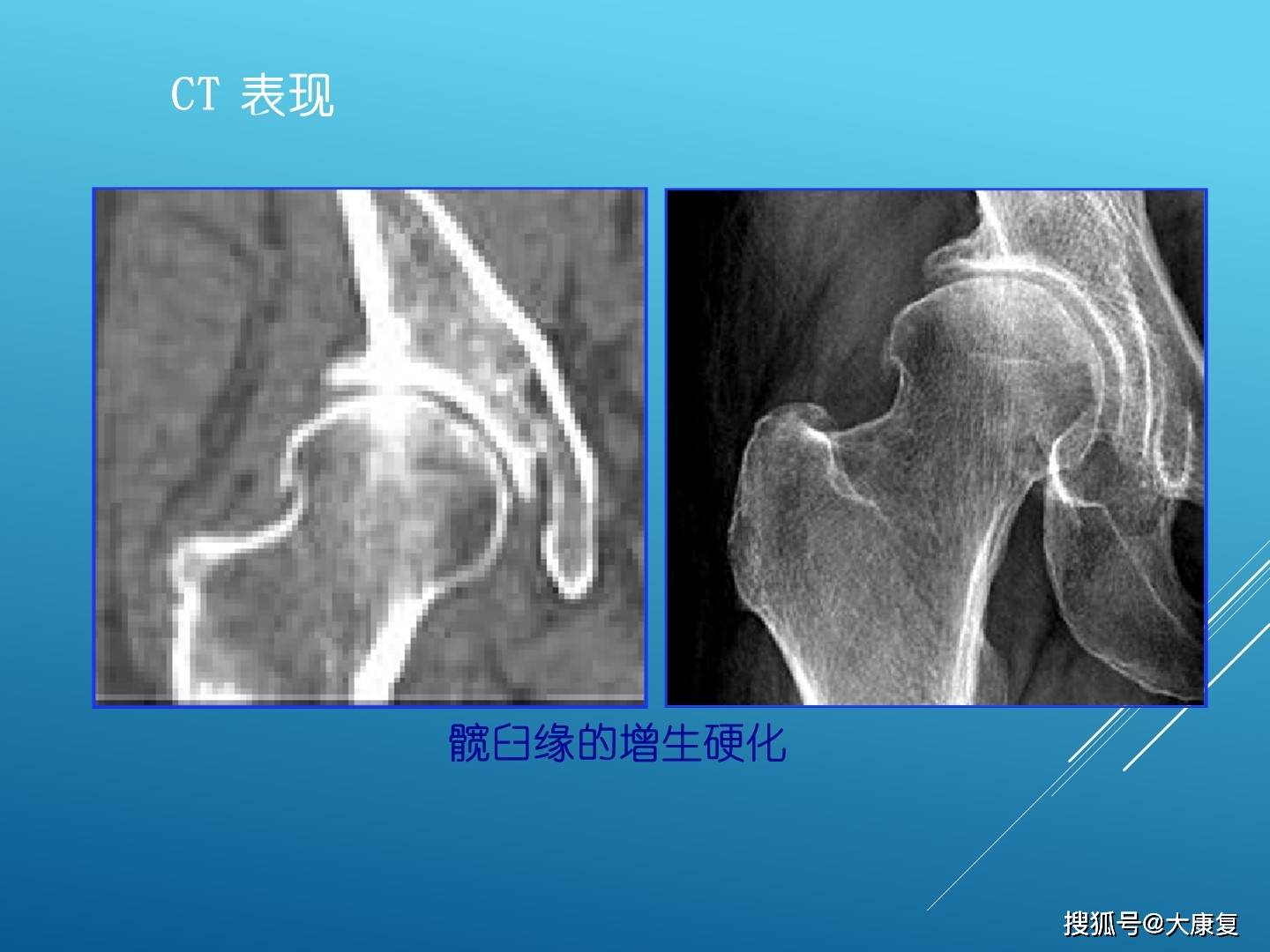 股髋关节撞击综合症