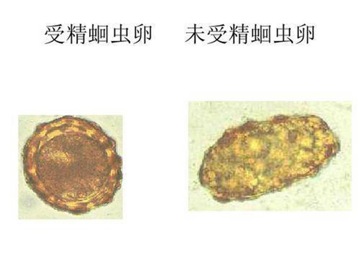 几十年前几乎人人肚子里都有蛔虫为何现在就没人感染蛔虫了