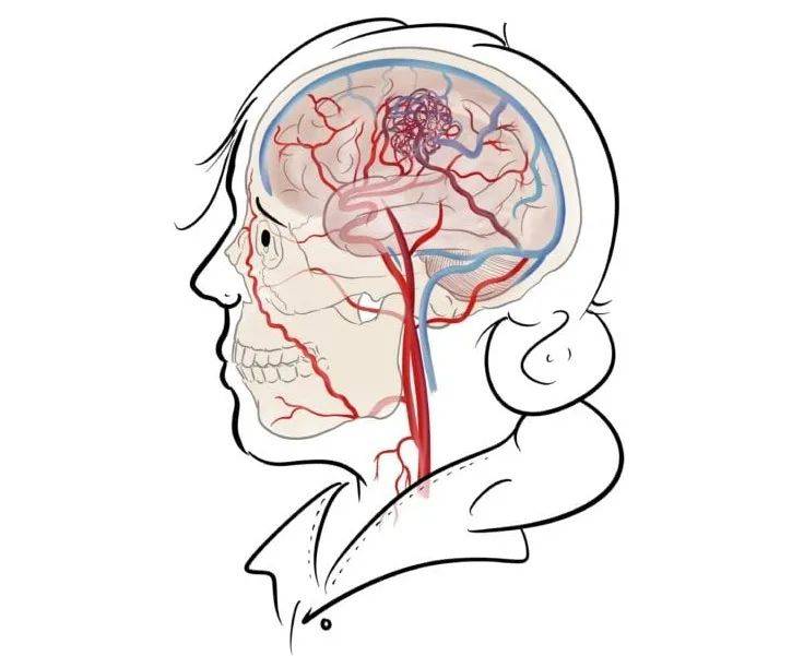脑血管畸形,是保守?还是手术?