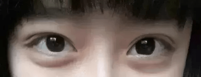 其成因主要是因为眶隔脂肪的先天性或遗传性过度发育