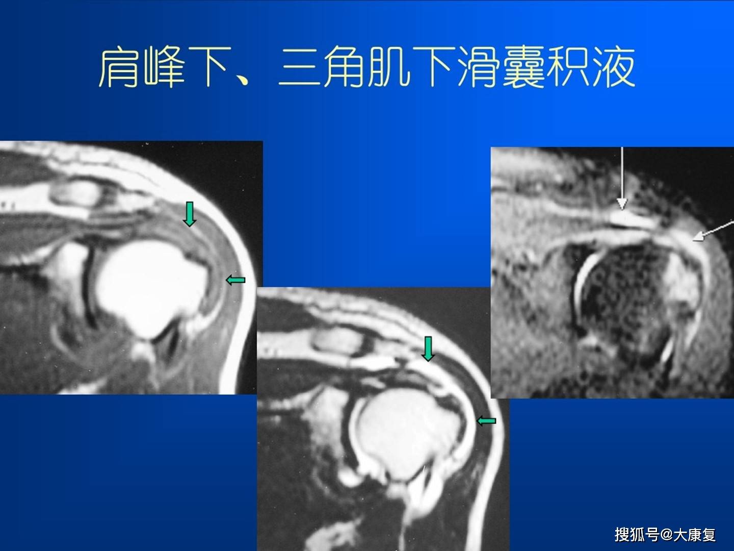 肩袖损伤mri诊断