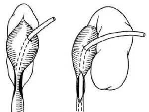02 治疗 输尿管可分为三段,输尿管上段,中段,下段狭窄的治疗方法不同