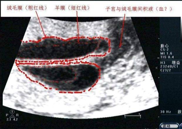 原创孕期做四维彩超发现是轮状胎盘,影响胎儿发育,一定要剖腹产吗?