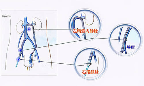 治疗精索静脉曲张大概多少钱?治疗费用取决于治疗方案_手术