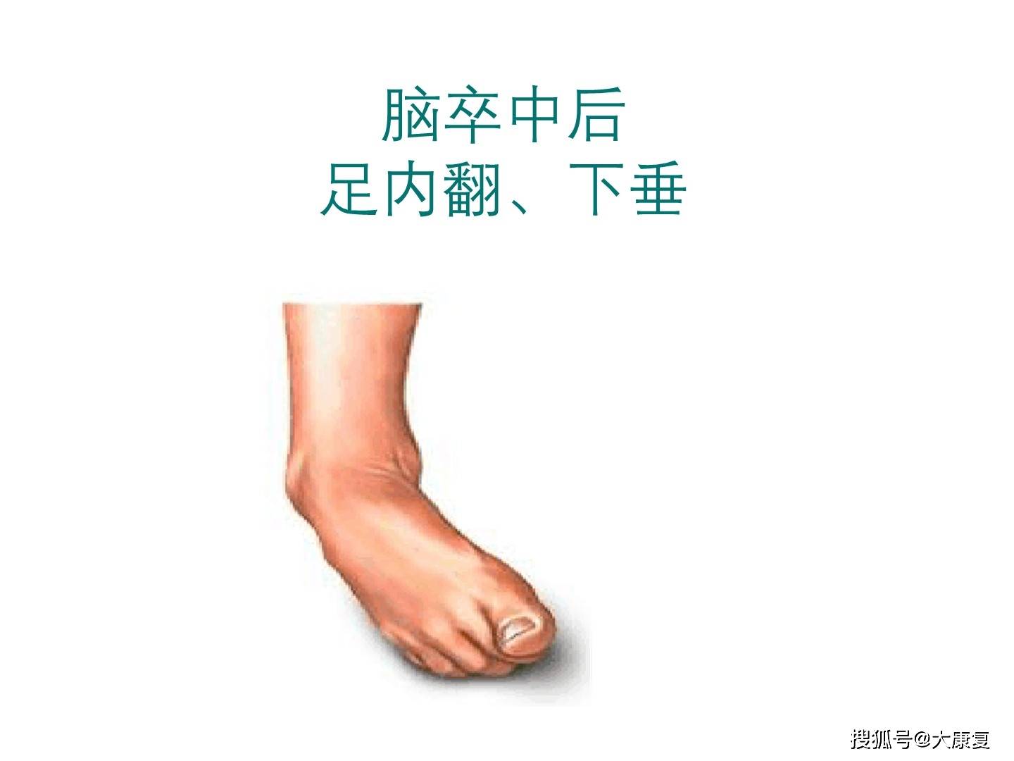 脑卒中后足内翻,下垂