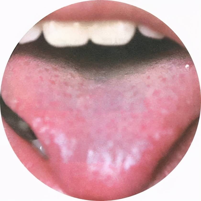 如饮用牛奶后苔呈白色;吃乌梅,杨梅,咖啡,陈皮梅,橄榄等可将舌苔染为