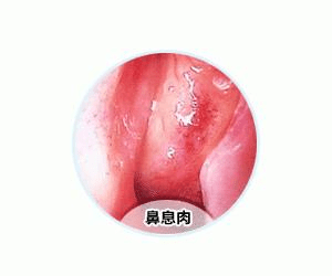 如前所述,息肉是在人体正常组织中生长出来的"赘肉",它属于良性肿瘤