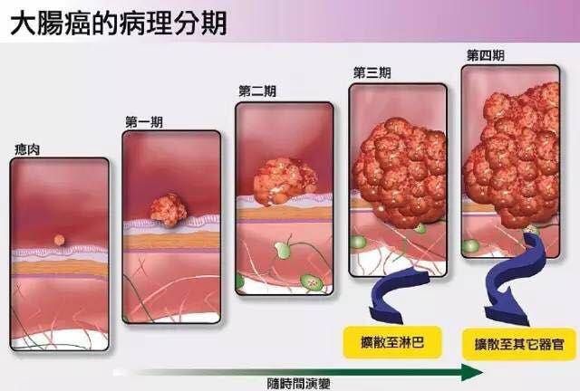 排便若出现这5症状,可能肠癌来报道