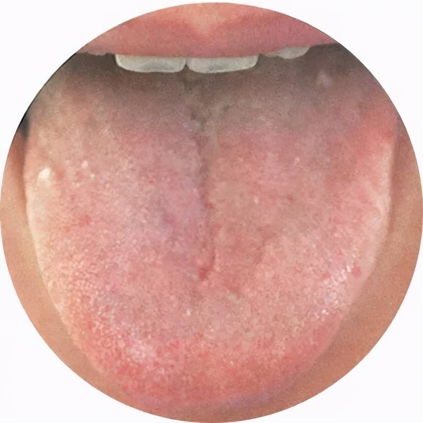舌苔:少苔或无苔 舌质:较红 舌面:有细小裂纹 此舌象提示身体肝肾阴虚
