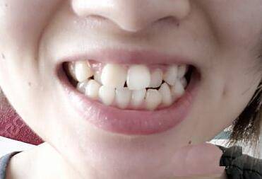 门牙歪斜门牙非常大牙齿的面相关系着一个人的肾气,所以通过牙齿的