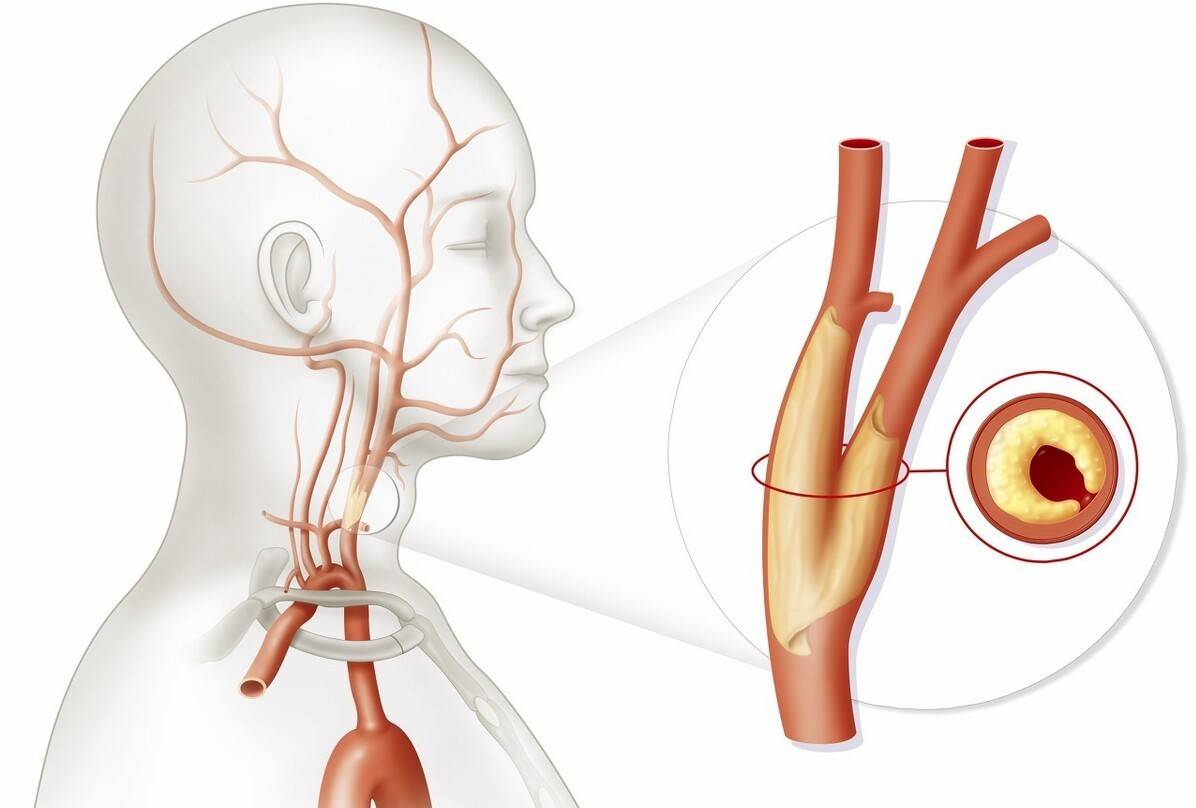 第一,颈动脉的解剖结构上有一处"y"型的分支,在分支处血流冲刷力量大