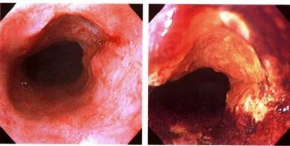 常见的并发症为食 道溃疡,食道狭窄,巴瑞特食管,食道癌.