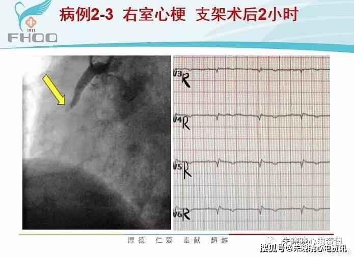 右室心肌梗死的心电图诊断