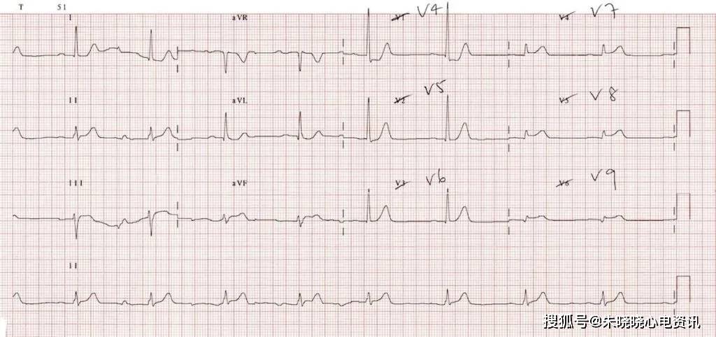 心肌缺血的心电图表现