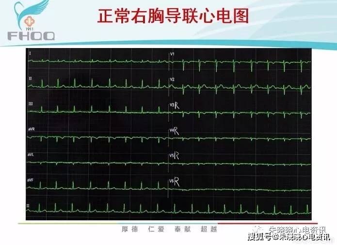 右室心肌梗死的心电图诊断