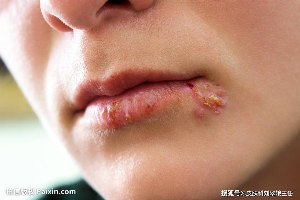 刘翠娥主任:皮肤上突然出现了水疱,可能是什么病?应该