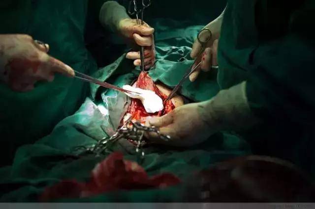 100张高清照片带你围观最真实的剖腹产手术