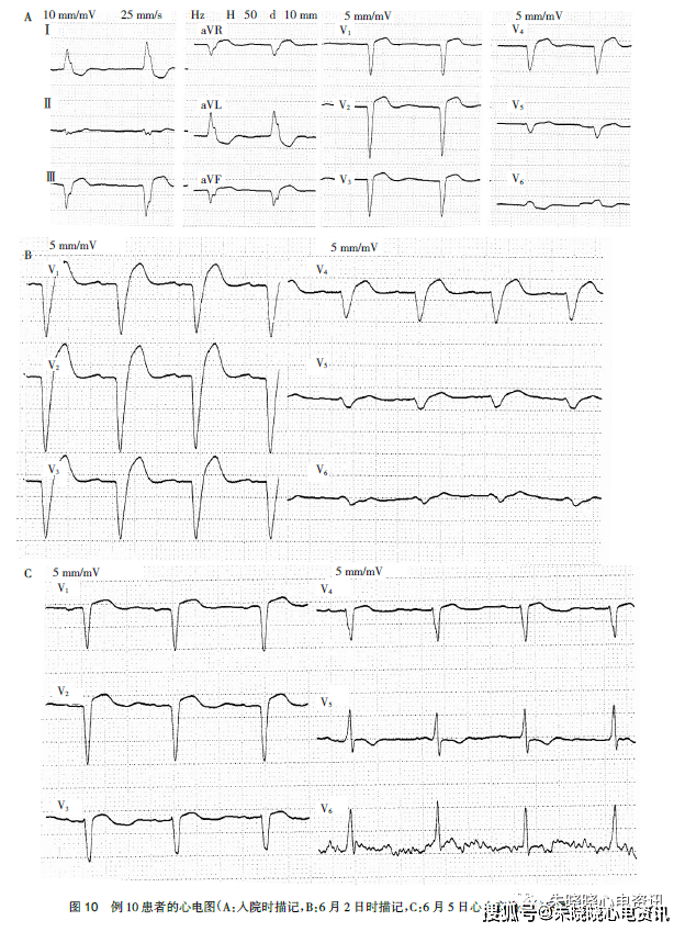 r波递增不良新概念:"掉头"现象--通过心电图诊断心力衰竭探讨