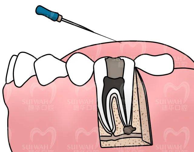 为什么牙齿表面只有一个小洞,却严重到需要根管治疗?