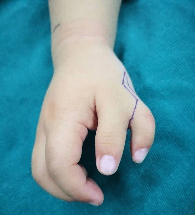 宝宝多一根手指,畸形矫形手术成功修复