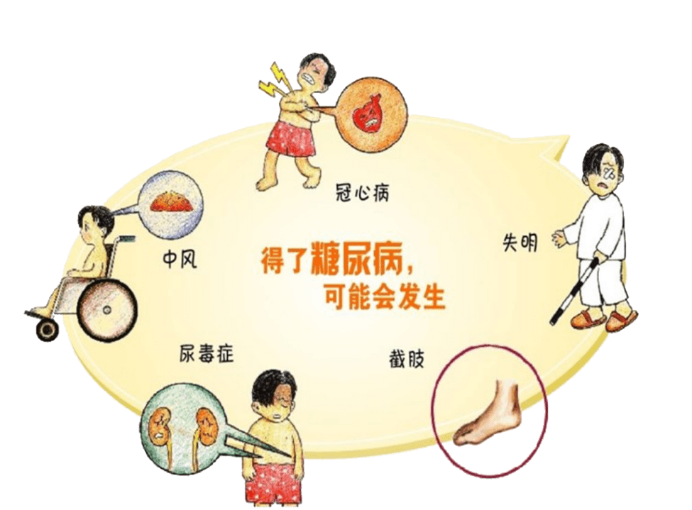 糖尿病并发症