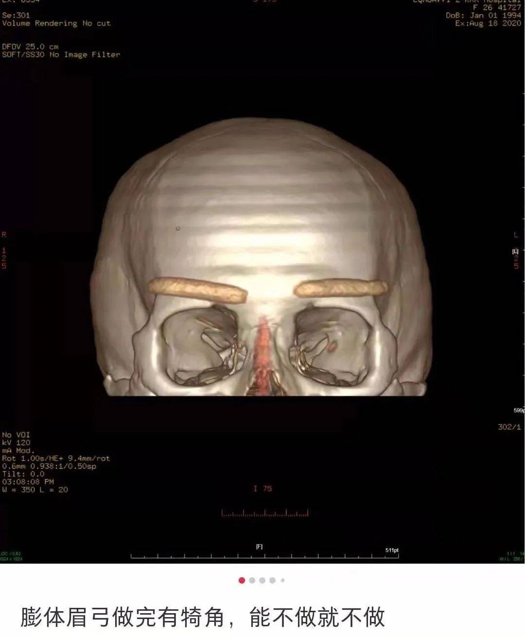 眉弓骨假体是美丽还是危险