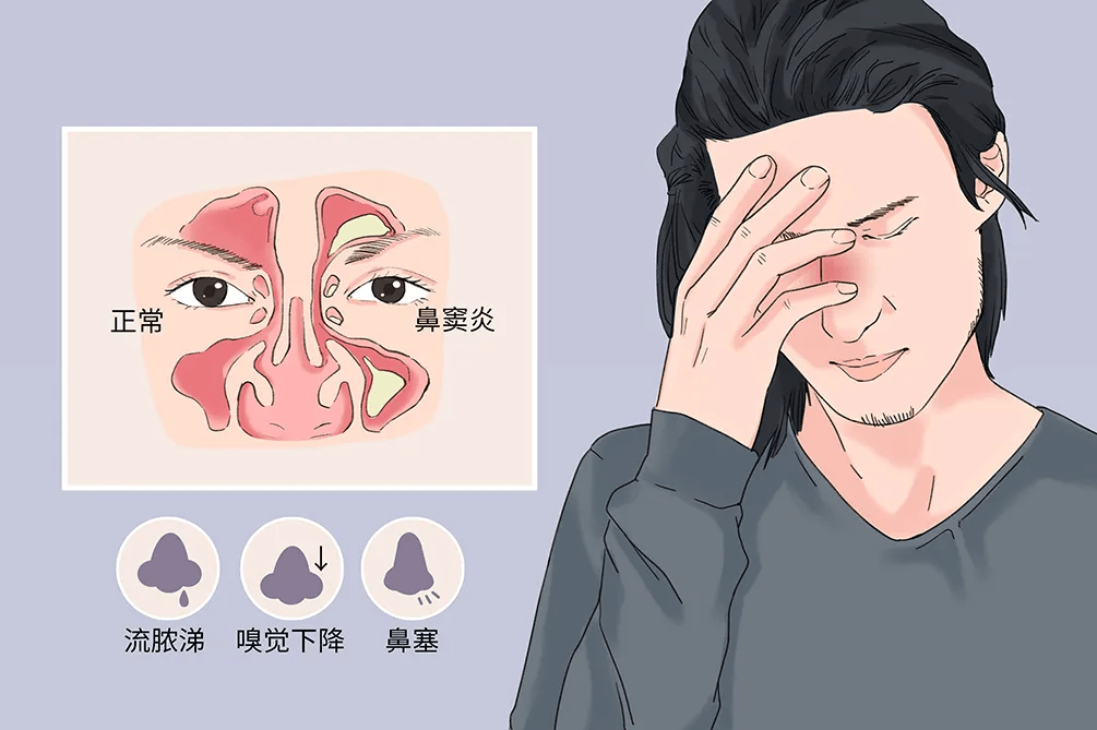 清鼻堂科普:出现这些症状需要引起警惕,可能是鼻窦炎找上门