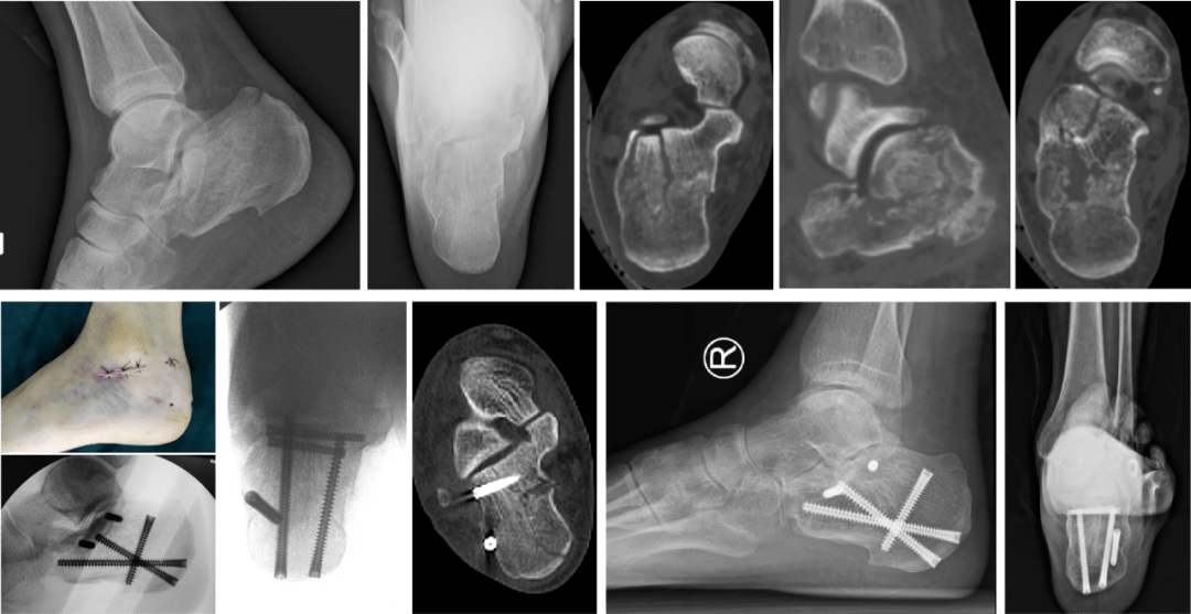 右跟骨骨折(sabders-Ⅲ),使用中心自行设计的微创钢板行微创orif,术后