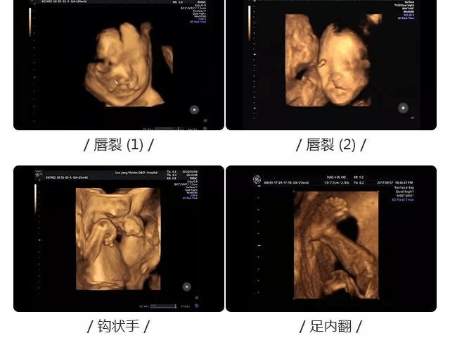 专家说:四维畸形排查很重要,孕妈不能只关注照片清晰度