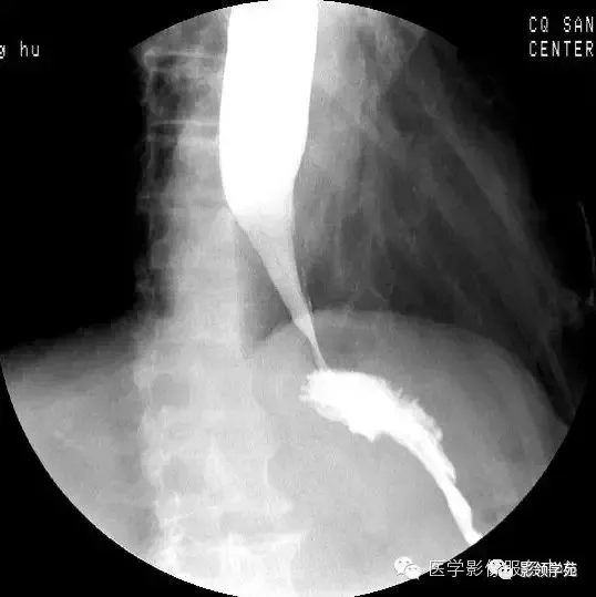 10种食管钡餐常见疾病图解