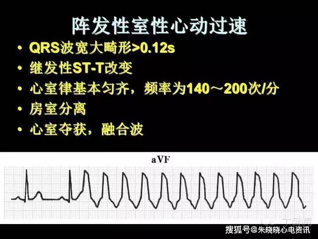 最全的心律失常心电图特征总结