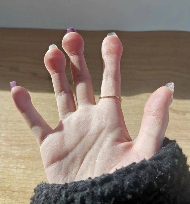 搞笑图片:女生的手指头肿成这样,到底是怎么弄的?