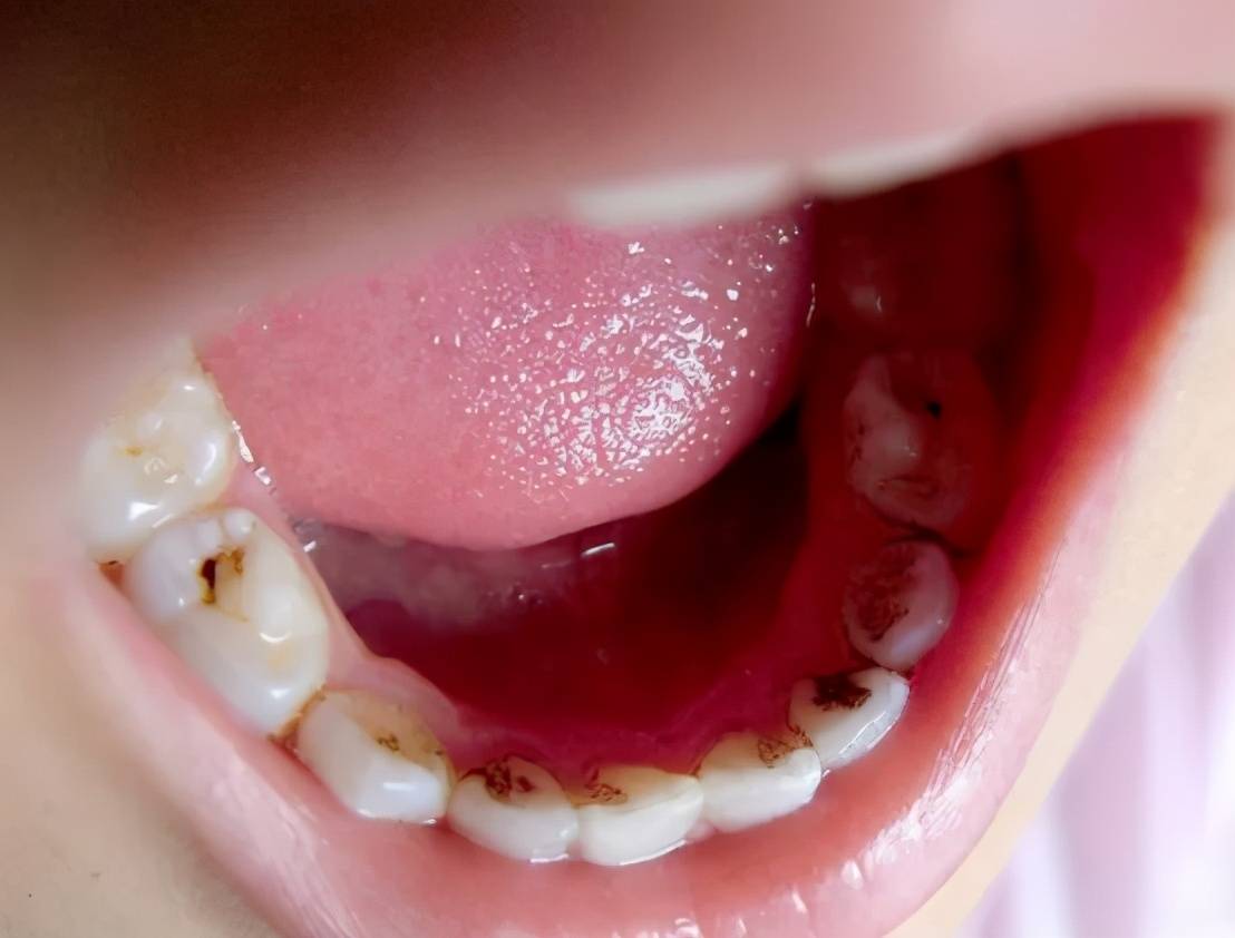 第一:及时就诊 一旦发现儿童牙齿存在黑色牙垢,牙釉质损坏,或有小黑点