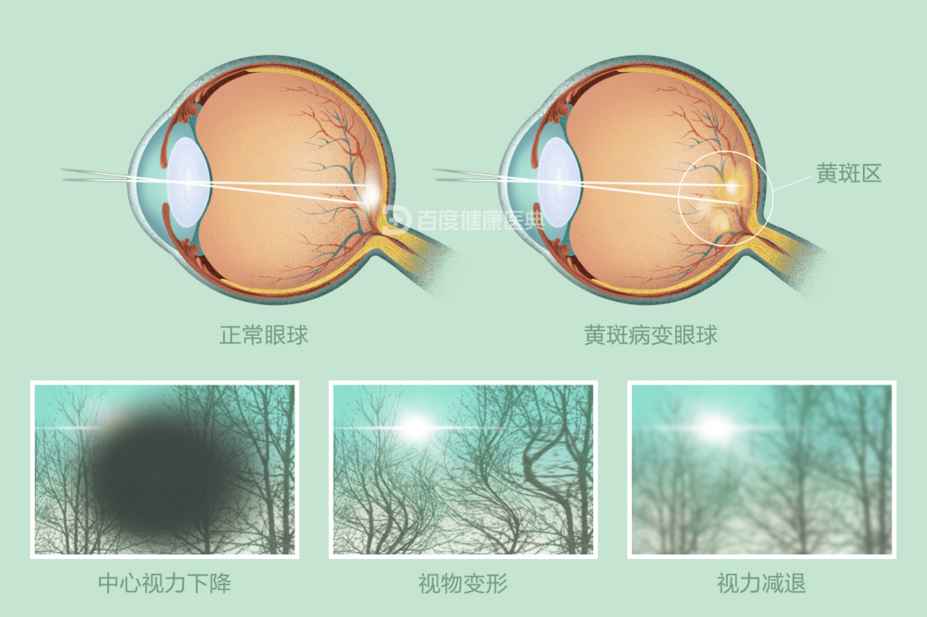 补充叶黄素,预防老年黄斑变性等眼部疾病